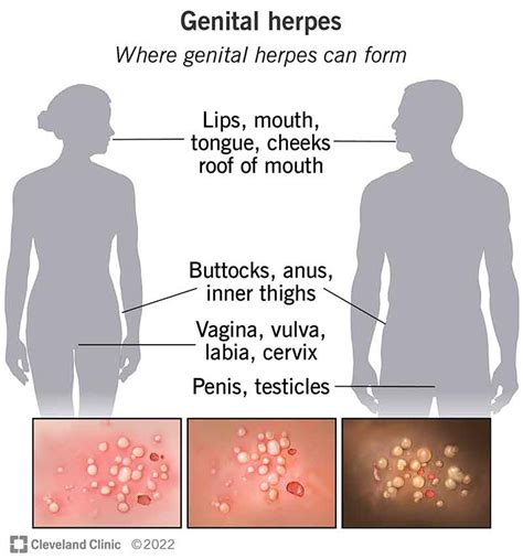 clitoral herpes|female symptoms of genital herpes.